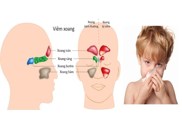 Các loại viêm xoang có thể được phân loại dựa trên mức độ nghiêm trọng hoặc tùy thuộc vào vị trí của xoang bị viêm