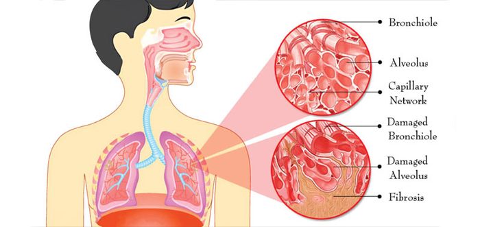 Xơ phổi xảy ra khi mô phổi chịu tổn thương nặng