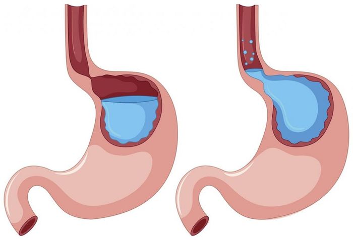 Khi axit dạ dày trào ngược lên thực quản, có thể gây ra triệu chứng khó thở.