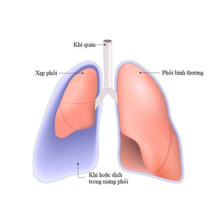 Bệnh tràn dịch màng phổi có thể phát sinh ở mọi độ tuổi