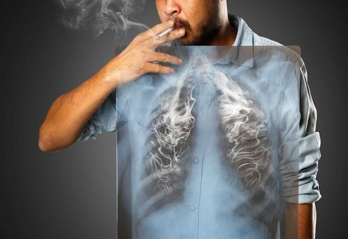 Hút thuốc lá là nguyên nhân hàng đầu gây ung thư phổi