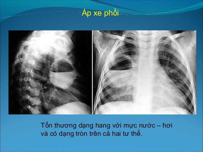 Hình ảnh chụp X-quang của một bệnh nhân mắc phải áp xe phổi