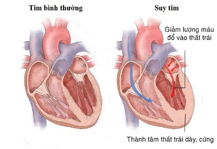 Tình trạng suy tim gây ra phù phổi cấp do tim