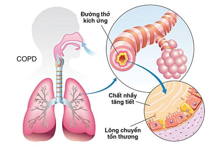 khó thở khi nằm xuống