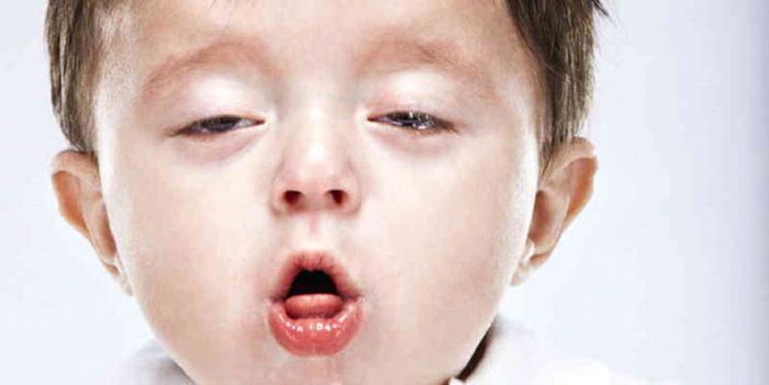 Viêm phổi ở trẻ có thể trở nặng nếu không được điều trị kịp thời