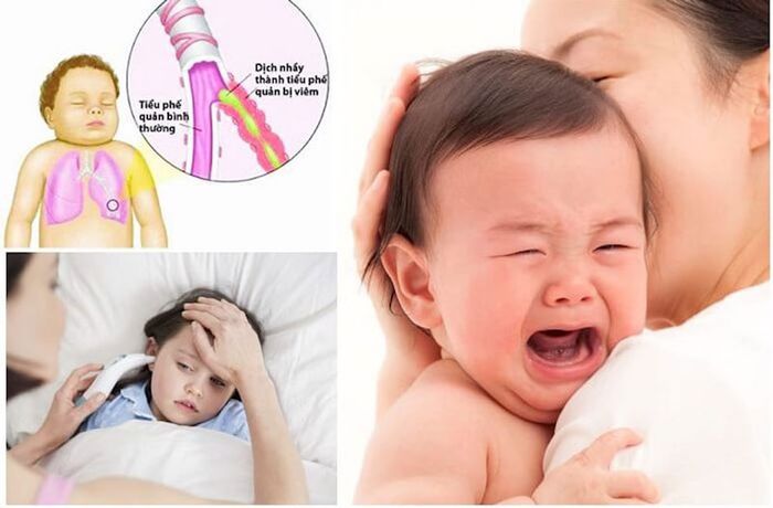 Chăm sóc sức khỏe cho trẻ mắc bệnh nhiễm khuẩn hô hấp