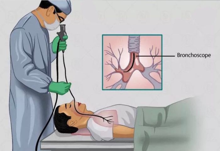 Mô phỏng phương pháp nội soi phế quản