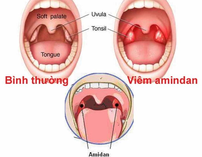 Viêm amidan là một căn bệnh dễ tái phát, gây ra nhiều triệu chứng không dễ chịu