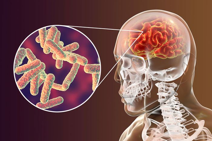 bệnh lao ở màng não có bị lây không