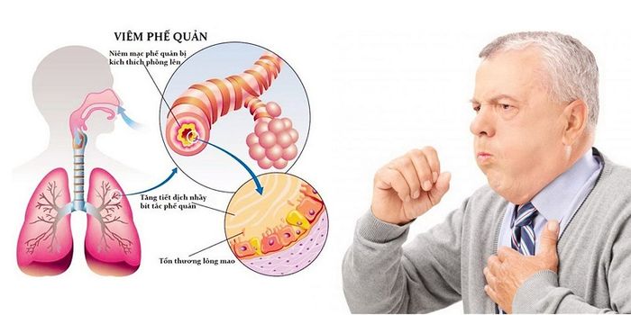 Ho, tức ngực và khó thở là các dấu hiệu của bệnh về đường hô hấp