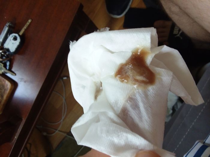 Ho đờm kéo dài không giảm, đờm kèm máu và mủ có thể là dấu hiệu của các bệnh hô hấp nguy hiểm
