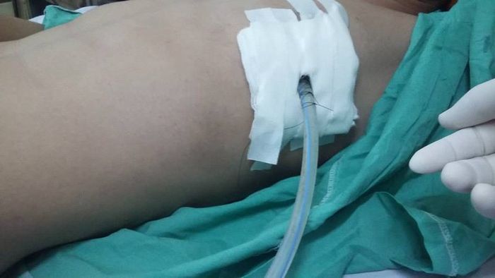 Kỹ thuật đặt ống dẫn lưu màng phổi trong quá trình điều trị tràn dịch màng phổi ác tính