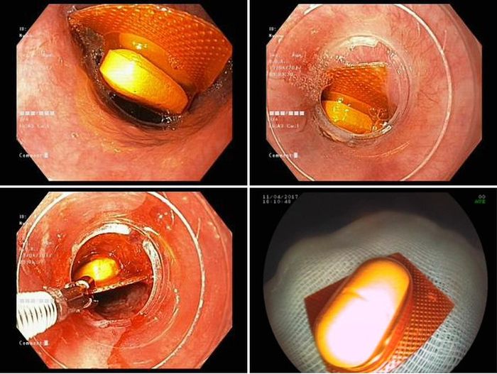 khó thở do vấn đề ở thanh quản
