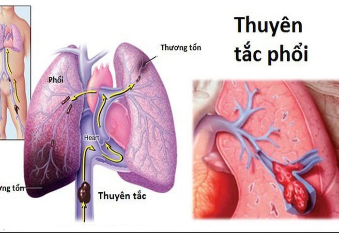 Cục máu đông có thể gây ra thuyên tắc phổi một cách nguy hiểm