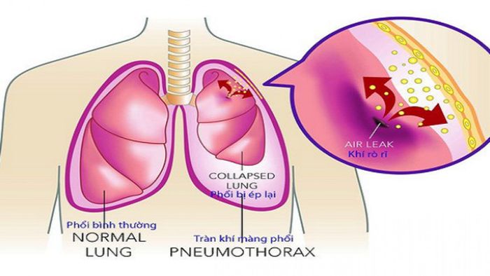 Viêm nước màng phổi ác tính thường dễ tái phát và khó điều trị hoàn toàn