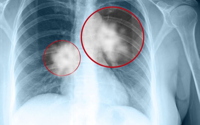 Chụp CT lồng ngực có thể phát hiện các biểu hiện không bình thường tại cơ quan này