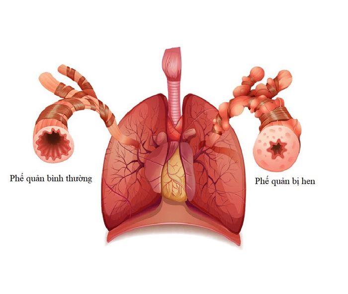 Hình ảnh minh họa phế quản