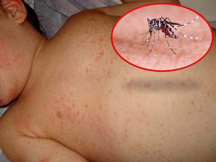Sốt xuất huyết ở trẻ em