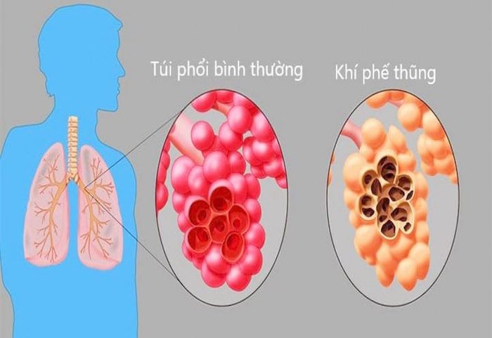 Túi phổi trong trạng thái bình thường và tác động của khí phế thũng lên túi phổi