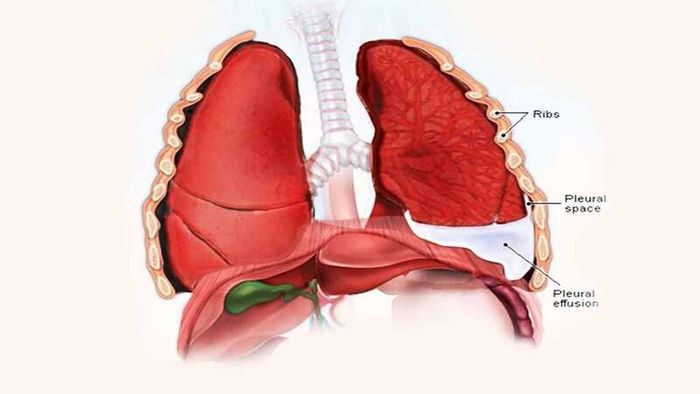 Bệnh tràn dịch màng phổi ác tính