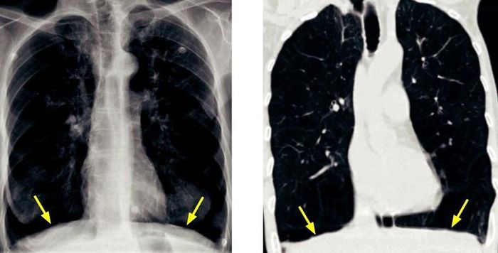 Hình ảnh chẩn đoán đóng vai trò quan trọng trong việc xác định bệnh khí phế thũng.