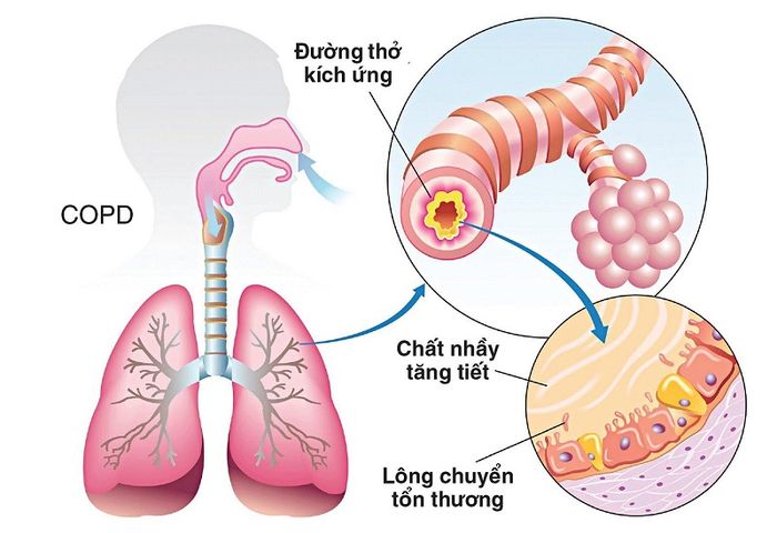 Bệnh tắc nghẽn phổi mãn tính gây hẹp đường thở.