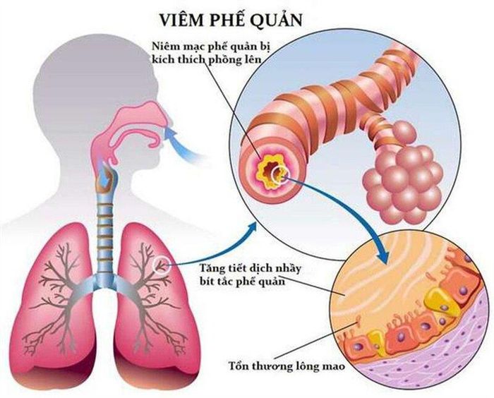 Vị trí tổn thương là ở lớp niêm mạc bên trong phế quản, nơi không khí đi qua trước khi vào hoặc ra khỏi phổi