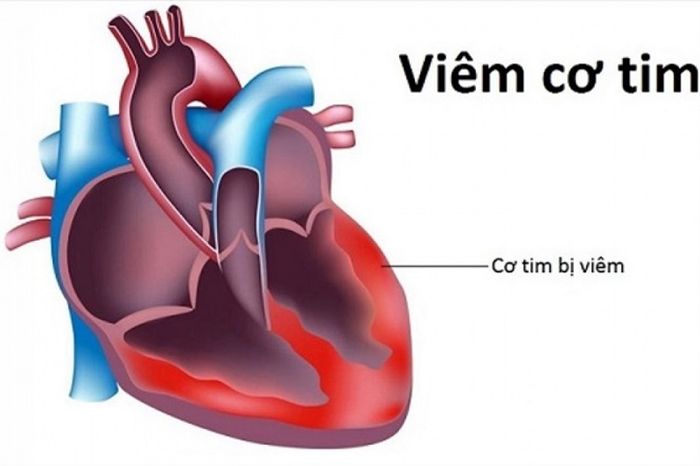 sốt virus