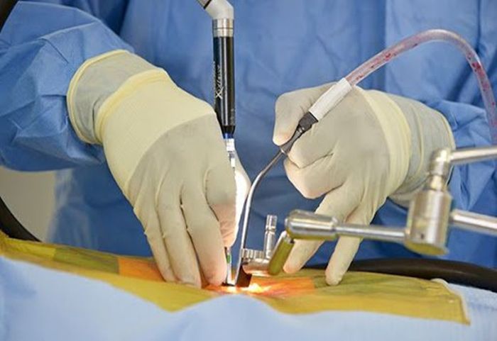 Cắt bỏ thùy phổi để điều trị ung thư và nhiều loại bệnh khác