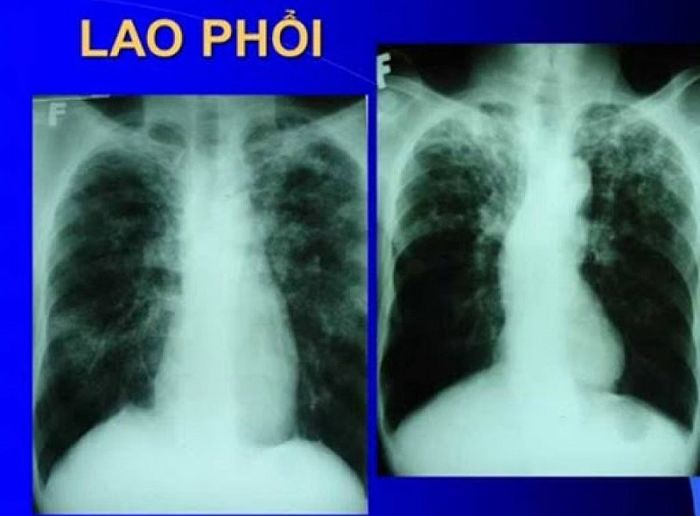 Vi khuẩn lao phổi là một trong số các nguyên nhân gây ra hiện tượng ho ra máu