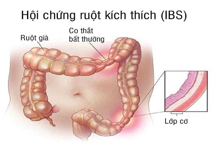 Hội chứng ruột kích thích có thể xuất hiện ở mọi lứa tuổi