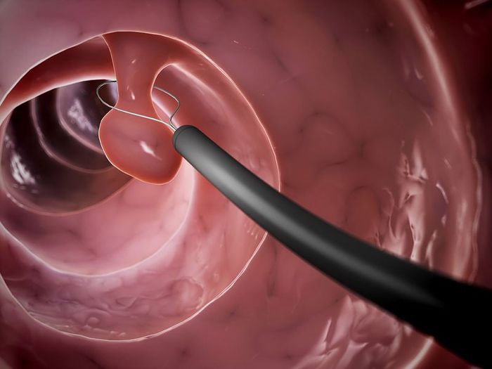 Thực hiện cắt polyp trong quá trình nội soi đại tràng
