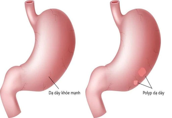 Polyp dạ dày là những đám tế bào xuất hiện trên niêm mạc dạ dày.