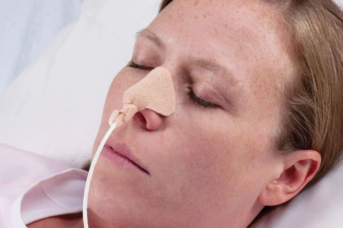Đặt ống dẫn dị dạ dày để cung cấp thức ăn cho bệnh nhân đang mất ý thức, không tỉnh táo