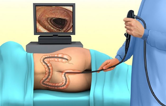 Nội soi đại tràng hỗ trợ bác sĩ trong việc quan sát và phát hiện các tổn thương ở đường tiêu hóa dưới