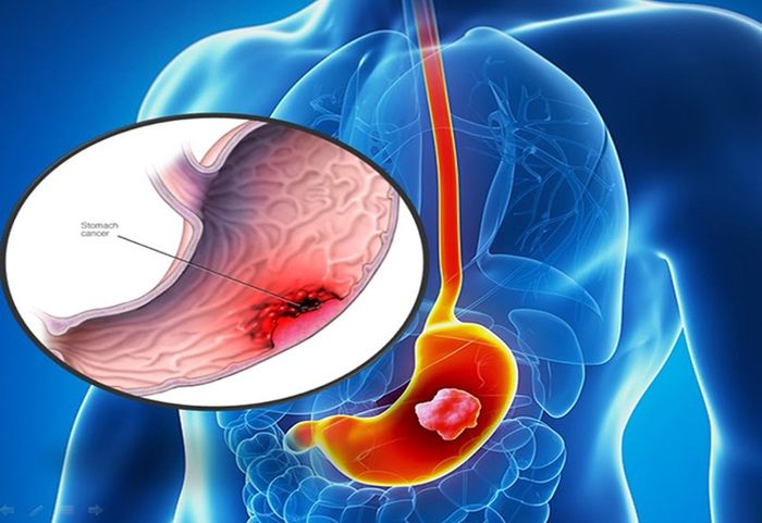 Dư axit dạ dày kéo dài có thể gây ra ung thư dạ dày