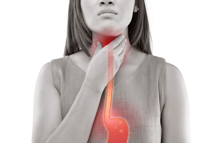 Cảm giác nóng, chua đắng là biểu hiện hàng đầu của trào ngược dạ dày