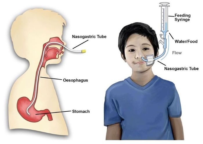 Việc đặt ống thông dạ dày có thể thực hiện qua đường mũi hoặc đường miệng