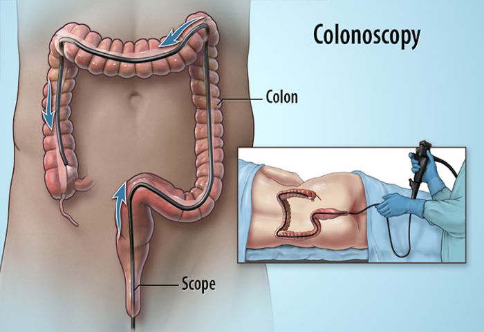 Phương pháp nội soi đại tràng