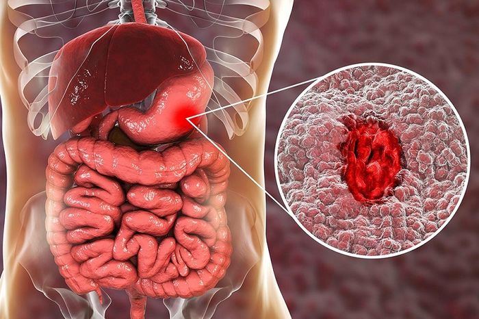 Viêm loét dạ dày là một bệnh thông thường liên quan đến hệ tiêu hóa