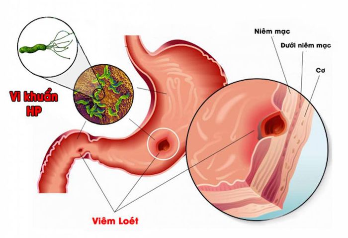 Vi khuẩn HP là nguyên nhân phổ biến gây đau dạ dày