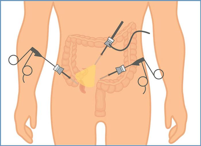 Phẫu thuật vẫn là biện pháp điều trị viêm ruột thừa hiệu quả nhất