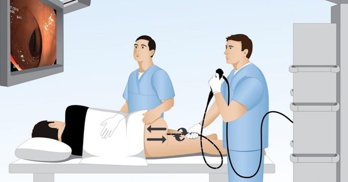 Mô phỏng quá trình nội soi đại tràng cho người bệnh