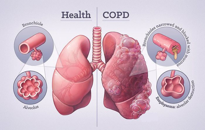 Hụt hơi là một trong những biểu hiện thường gặp ở người mắc COPD khi thở.