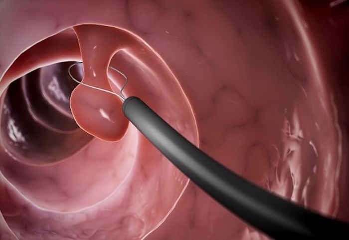Nội soi dạ dày là phương pháp quan trọng để phát hiện polyp.