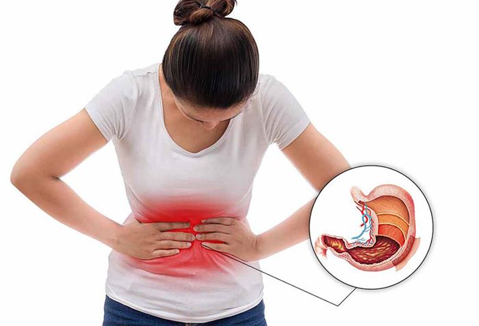 Khó chịu, buồn nôn là biểu hiện của viêm loét dạ dày