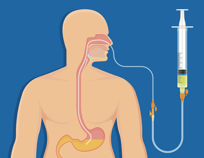 Người mắc bệnh nặng hoặc gặp tai nạn, hôn mê có thể được thực hiện đặt ống dẫn dạ dày.