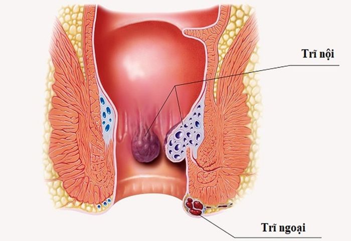Phân có máu có thể là do bệnh trĩ.