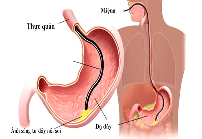 Mô phỏng phương pháp nội soi bao tử qua đường miệng