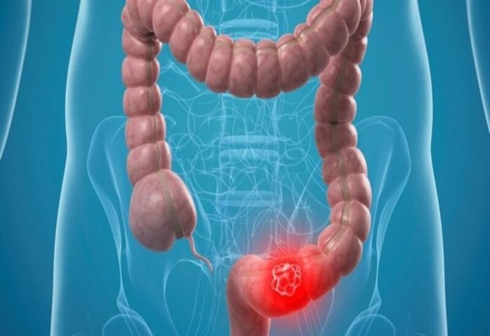 Phân có máu có thể do bệnh Crohn.